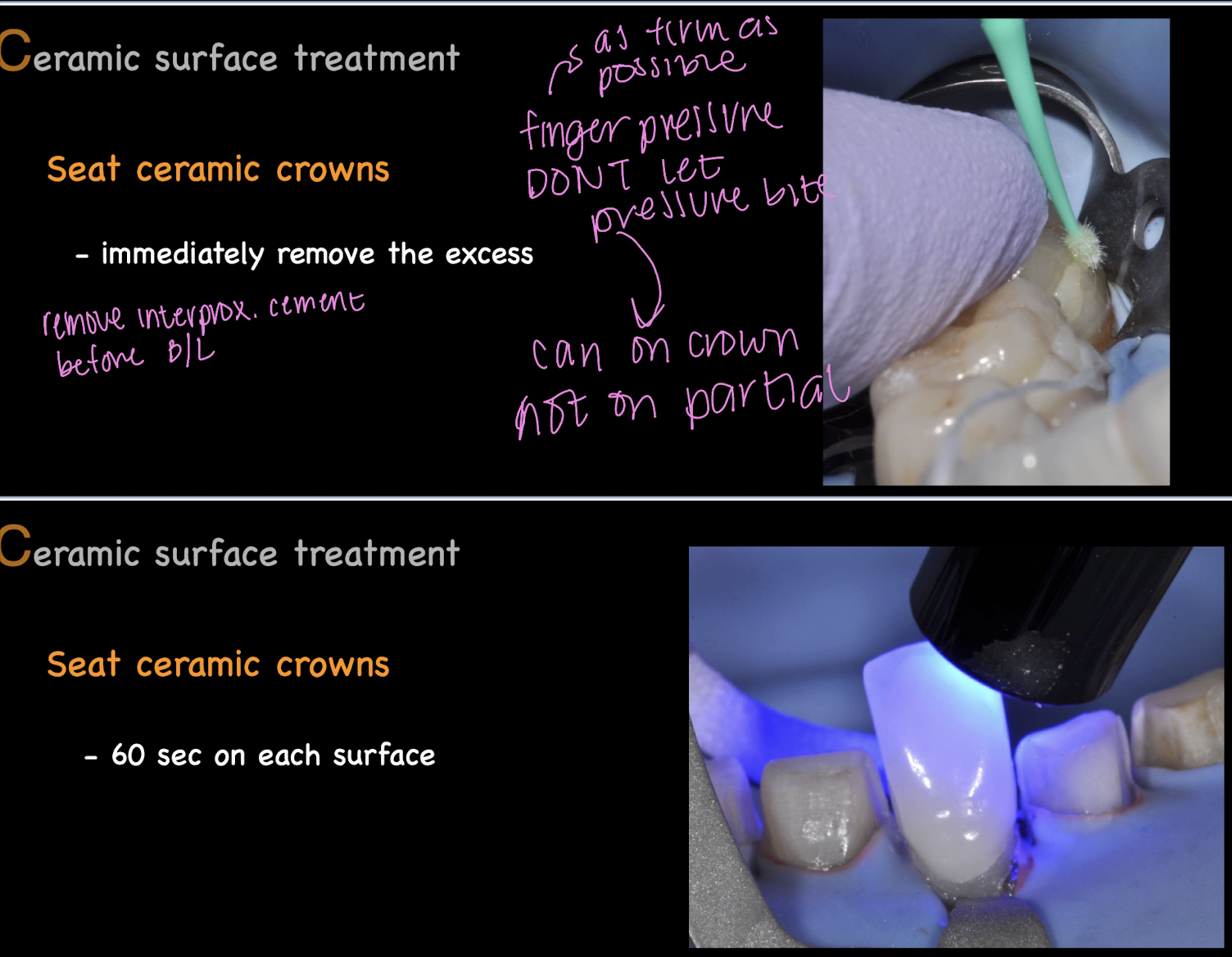 <ol><li><p>immediately remove the excess </p></li><li><p>60 sec light cure from each surface </p></li></ol><p></p>