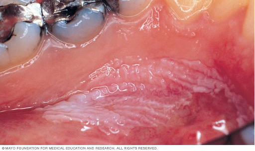 <p>CASE: A 1.8-cm heterogeneous oral lesion is clinically suspicious for premalignancy or malignancy. You do not want to remove the entire lesion before diagnosis. What biopsy type is indicated?</p>