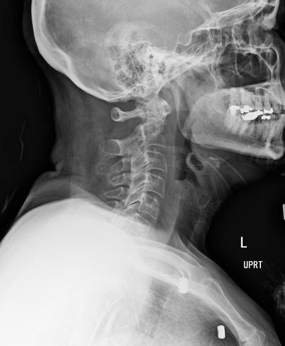 <p><span>Evaluate the Lateral C-spine radiograph below and select any of the statements that are true (multiple answers possible):</span></p><ol><li><p><span>All required vertebrae are demonstrated</span></p></li><li><p><span>A repeat with more flexion of the head/neck is needed</span></p></li><li><p><span>The R/L marker is correct</span></p></li><li><p><span>This is a well-positioned radiograph; no repeat required.</span></p></li></ol><p></p>