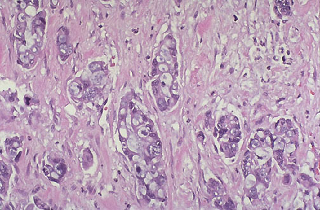 <p>poorly differentiated glands and extensive desmoplasia (collagenous stroma)</p>