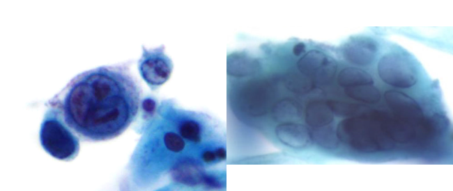 <p>Pap smear: the cells are most consistent with </p>