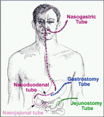 <p>percutaneous endoscopic jejunostomy tube - feeding tube</p>