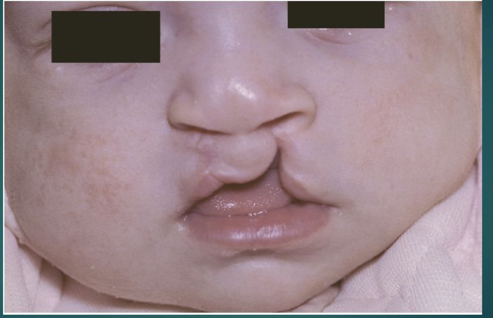 <p>Defective <span style="color: rgb(255, 96, 132);"><strong>fusion of the medial (median) nasal process with the maxillary process.</strong></span></p>
