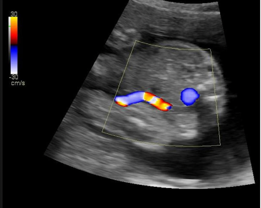 <p>What is represented by the blue circle of color Doppler displayed on the image?</p><p>A. umbilical varix</p><p class="p1">B. inferior vena cava</p><p class="p1">C. umbilical artery</p><p class="p1">D. aorta</p>