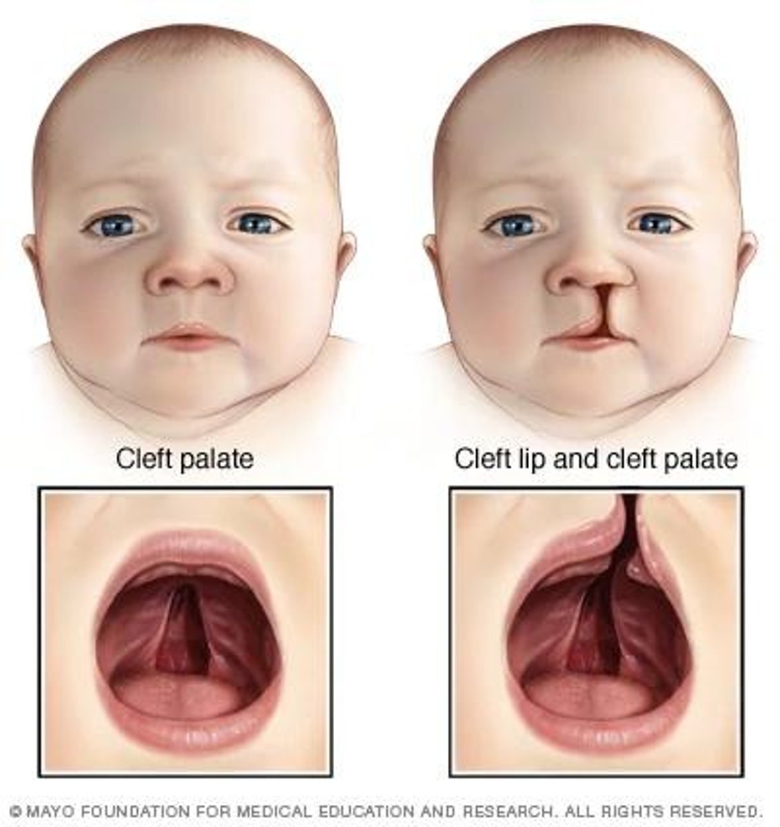 <p>Deep groove of the lip upward to the nose as a result of portion of the lip failing to close during prenatal development</p>