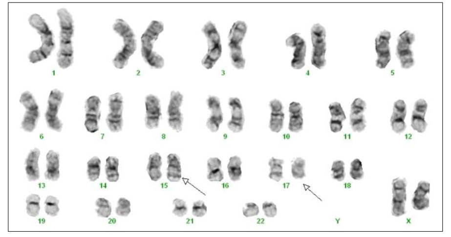 <p>APML Cytogenetics</p>