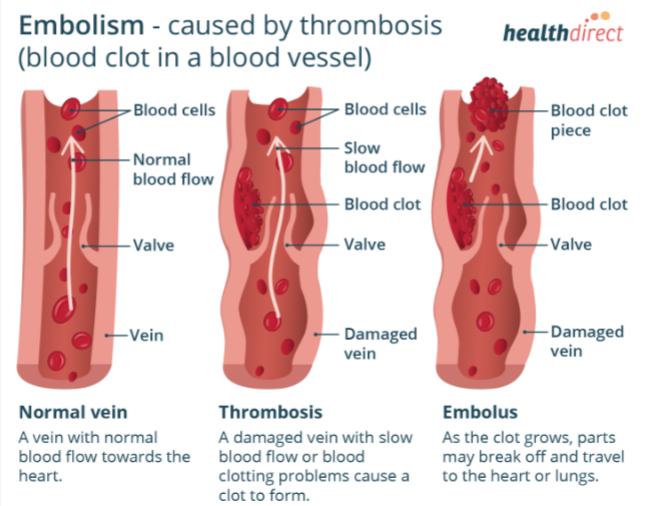 <p>A mass traveling through the circulatory system</p><p>Lodges in a blood vessel in the brain</p>