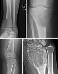 <p>What is this?</p><p>- 20-40 yo</p><p>- Pain (local)</p><p>- Metaphyseal - Distal femur/ radius, Proximal tibia/ humerus</p><p>- Extends to subarticular surface (Patella & Sacrum)</p>