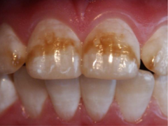 <p>What ICDAS score would be given to this tooth?</p>