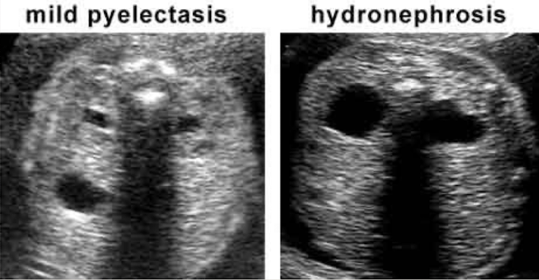 <ul><li><p><span style="color: red;">before 27w = >4mm </span><span>is abnormal </span></p></li><li><p><span style="color: red;">after 27w = >7mm</span><span> is </span>abnormal</p></li></ul><p></p>