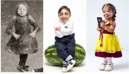 <ul><li><p>diagnosis based on delayed growth and development</p></li><li><p>hormone testing confirms specific deficiencies </p></li><li><p>growth hormone therapy used before plate closure </p></li><li><p>early treatment improved growth and outcomes</p></li><li><p>systemic complications depend on underlying cause </p></li></ul><p></p>