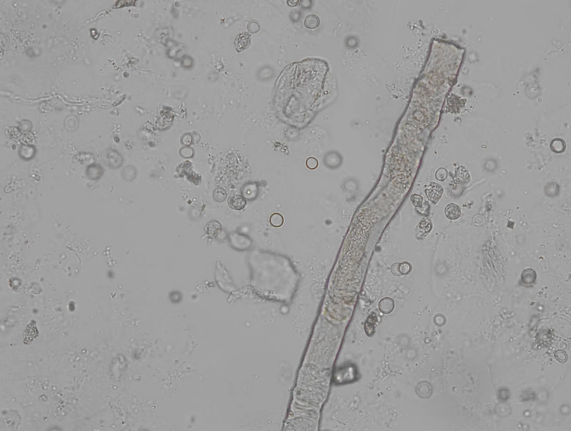 <p>What type of cast is this, and what does its presence indicate?</p>