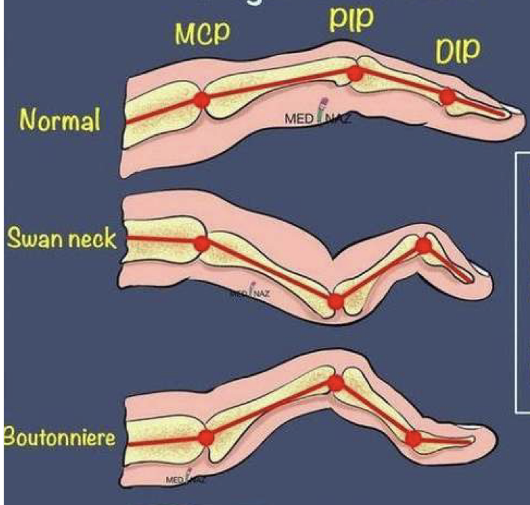<p>Rheumatoid arthritis finger deformities</p>