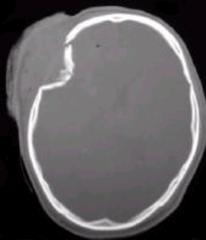 <p>high-energy blow to small area of skull (ex hammer)</p>