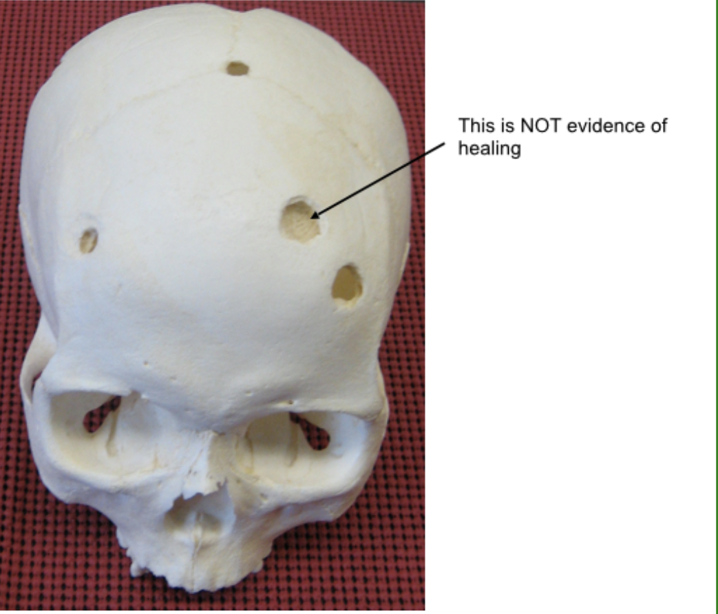 <p>is this injury antemortem, perimortem, or postmortem?</p>