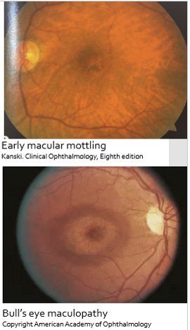 <ul><li><p>Decreased central vision</p></li><li><p>Abnormal dark adaptation</p></li><li><p>Hemeralopia (poor vision in bright light)</p></li></ul><p></p>