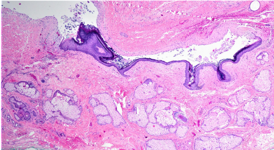 <p>A 35 year presented with cystic swelling on lateral part of forehead of 2 cm diameter. The microscopic image is shown below.</p>