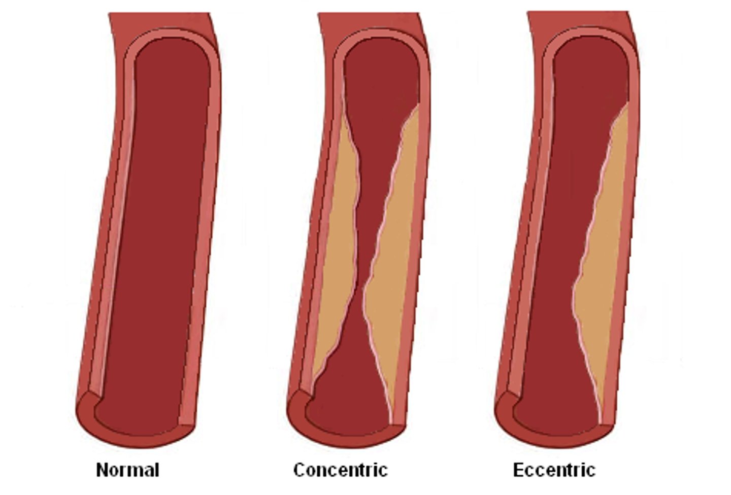 <p>Plaque that only covers part of the diameter of the artery.</p>