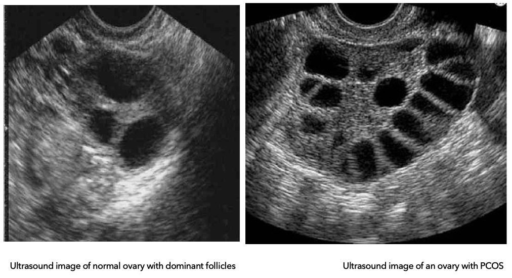 <p><strong><u>Diagnostics: Ovarian Types</u></strong></p><ul><li><p><strong>Normal ovary:</strong></p><ul><li><p>Multiple follicles develop</p></li><li><p>One becomes <strong>dominant → ovulation (egg released)</strong></p></li><li><p>Others <strong>regress and are reabsorbed</strong></p></li></ul></li></ul><ul><li><p><strong>PCOS ovary:</strong></p><ul><li><p>Follicles <strong>begin to grow but get arrested</strong> (don’t fully mature)</p></li><li><p><strong>No dominant follicle → no ovulation</strong></p></li><li><p>Follicles <strong>do not regress</strong> → accumulate in ovary</p></li></ul></li></ul><p></p>