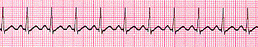 <p>Which of the following is represented in the above rhythm strip?</p><ol><li><p>Sinus tachycardia</p></li><li><p>Atrial tachycardia</p></li><li><p>Ventricular tachycardia</p></li><li><p>Asystole</p></li></ol><p></p>