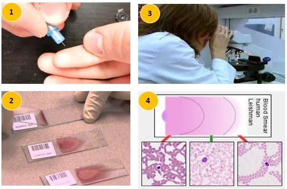 <p><span style="color: blue;"><strong><em><mark data-color="#9cefad" style="background-color: rgb(156, 239, 173); color: inherit;"><sub><sup>Muestra de material biológico como sangre, secreciones, exudados, aspirados, cultivos, etc., que se extiende para su análisis sobre un portaobjetos y puede protegerse con un cubreobjetos; se fija al aire con calor o algún líquido especial y se somete a tinciones.</sup></sub></mark></em></strong></span></p><p><strong><mark data-color="#f3f47d" style="background-color: rgb(243, 244, 125); color: inherit;"><sub><sup>Fuente:</sup></sub></mark></strong><sub><sup> Real Academia Nacional de Medicina de España. Frotis [Internet]. Madrid: Real Academia Nacional de Medicina de España; 2012 [citado 10 de abril de 2026].</sup></sub></p>