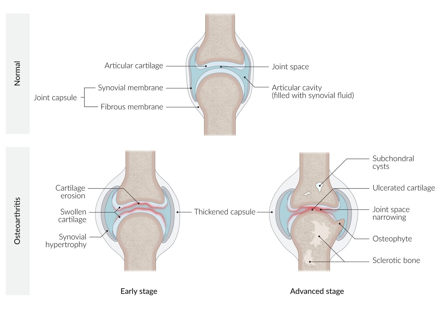 <ol><li><p>Chronic mechanical stress on joints + decreased proteoglycans (age-related) = Decreased articular cartilage elasticity</p></li></ol><ul><li><p>Increased friability</p></li></ul><ol start="2"><li><p>Cartilage degeneration + inflammation + swelling = Joint space narrow and thicken + subchondral bone sclerosis</p></li></ol><ul><li><p>Chondrocyte hypertrophy = Fibroblast-like collagen production = Decreased elasticity + thicken joint articular cartilage</p></li></ul><ol start="3"><li><p>Bone tissue attempt to repair damage = Osteophyte formation (bone outgrowth)</p></li></ol><p></p>