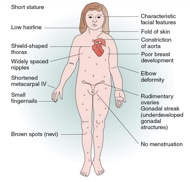 <ul><li><p>Monosomie 2n-1</p></li><li><p>45, X0à=</p></li><li><p>petite taille </p></li><li><p>insuffisance ovarienne (entraînant souvent une infertilité)</p></li></ul><img src="https://assets.knowt.com/user-attachments/a48ff113-0cef-4df6-9aa6-7e32c329d710.png" data-width="100%" data-align="center"><p></p>