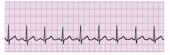 <p>A PT examines the output from a single lead ECG of a patient in an inpatient clinic. the 6 second ECG strip is shown in picture below. What should the PT determine the heart rate of the patient as? </p><p>a. 110 bpm </p><p>b. 70 bpm </p><p>c. 90 bpm </p><p>d. 60 bpm </p>
