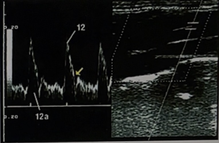 <p><span>What causes this "notch" (indicated with the yellow arrow) in the envelope of this spectral Doppler waveform of a normal artery?</span></p>