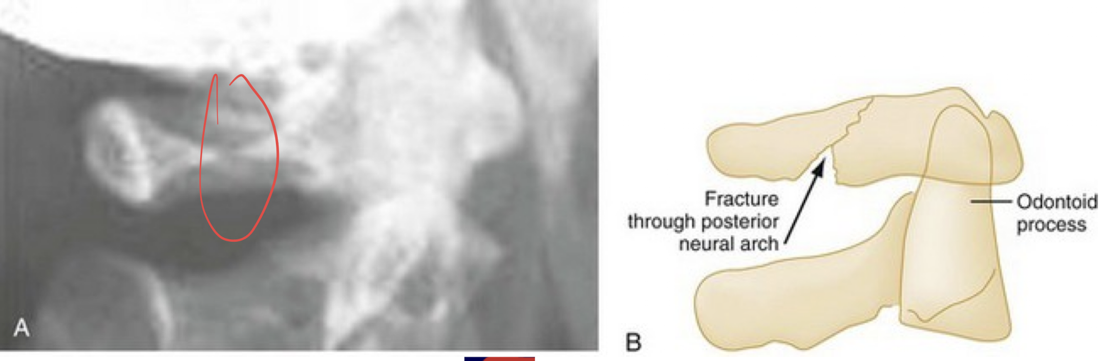 <p>Head is hyperextended and posterior neural arch of C1 is compressed between the occiput and the spinous process of C2</p><p></p>