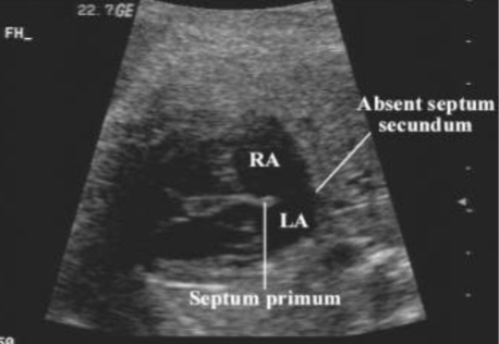 <p>which atrial septal defect is this?</p>