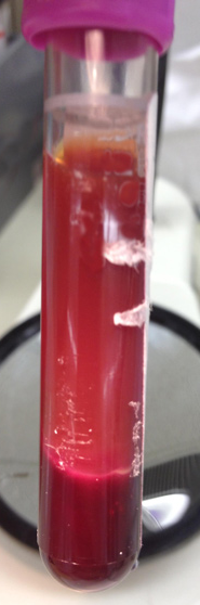 <p>This RBC sample shows which process?</p>