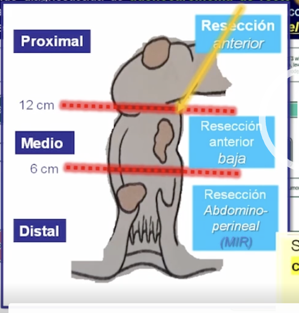 <p>Cuanto mas cerca el tumor del ano, mas útil es la </p>
