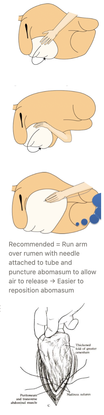 <ol><li><p>Right flank laparotomy</p></li><li><p>Systematic exploration of abdominal cavity</p></li><li><p>Reached over rumen and deflate abomasum with needle with flutter valve attached to a long tube</p></li><li><p>Reposition abomasum</p></li><li><p>Omentopexy = Tack omentum to ventral abdominal wall to prevent future abomasal displacement</p><ol><li><p>Pull omentum through incision until pylorus can just be seen</p></li><li><p>Place mattress sutures through peritoneum, omentum and muscle</p></li><li><p>Place continuous sutures on inner layers of muscle incorporating the omentum</p></li></ol></li></ol><p></p>