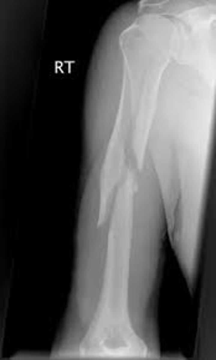 <p>radial nerve and profunda brachii run immediately against it in spiral groove</p>
