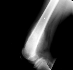 <p>What is the diagnosis of the patient with local pain?</p>
