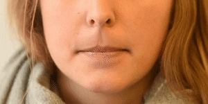 <p>Lip Suck</p>
