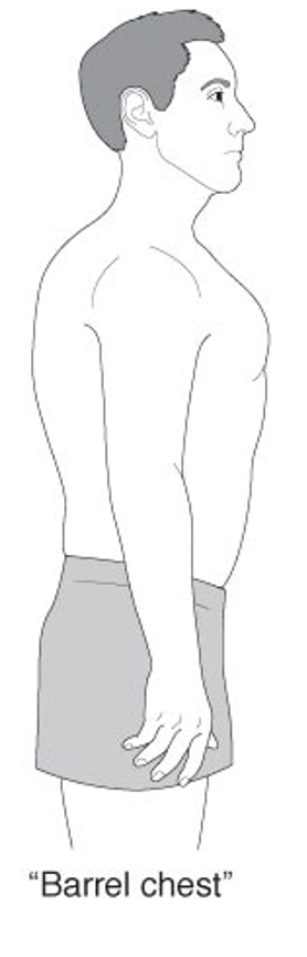 <p>barrel chest </p>