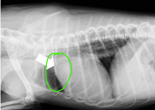 <p>Aortic stenosis</p>
