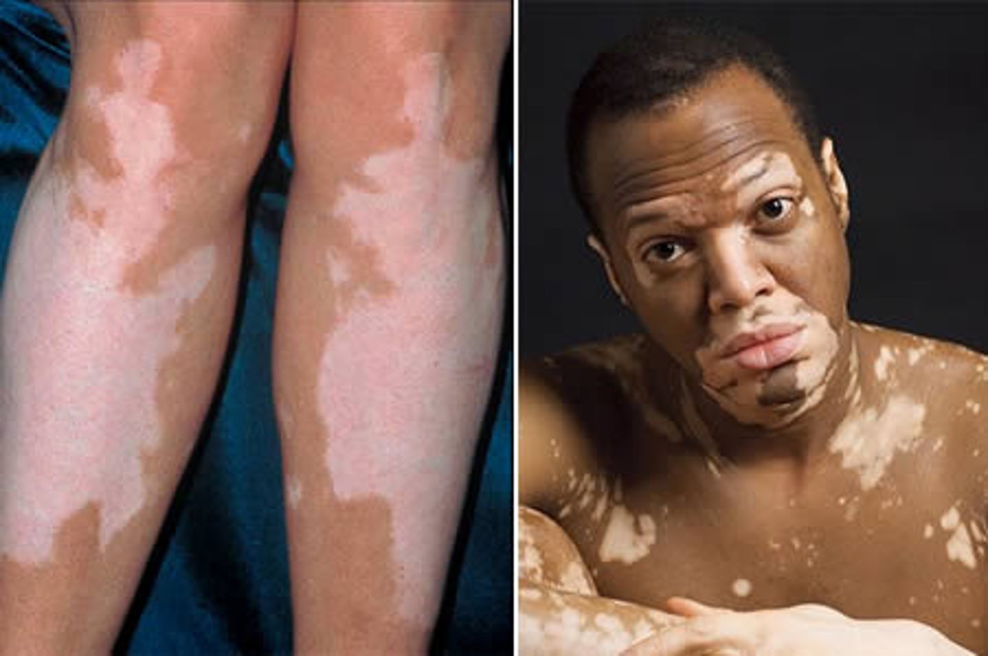 <p>autoimmune destruction of melanocytes causing depigmented patches</p><p>- can be associated with systemic disease or idopathic</p>