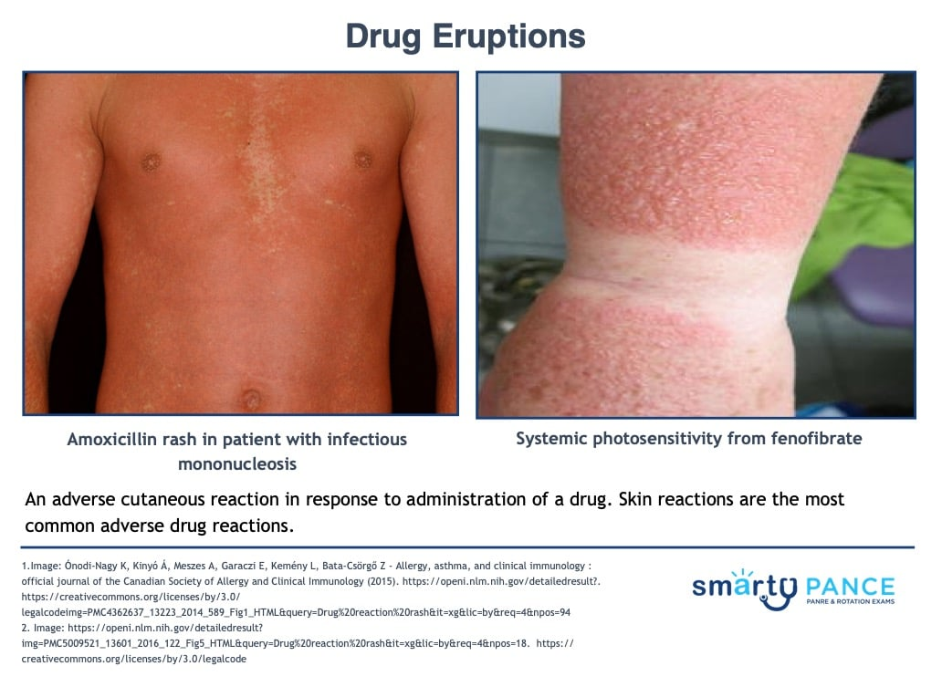<p>Adverse skin reaction to medicine, usually appearing within the prior 6 weeks</p><p>-Presentation: mild, morbilliform rash that clear after stopping the drug ranging to severe life-threatening reactions</p><p>-Dx: clinical with careful history</p><p>-Tx: withdraw the offending agent, antihistamines </p>