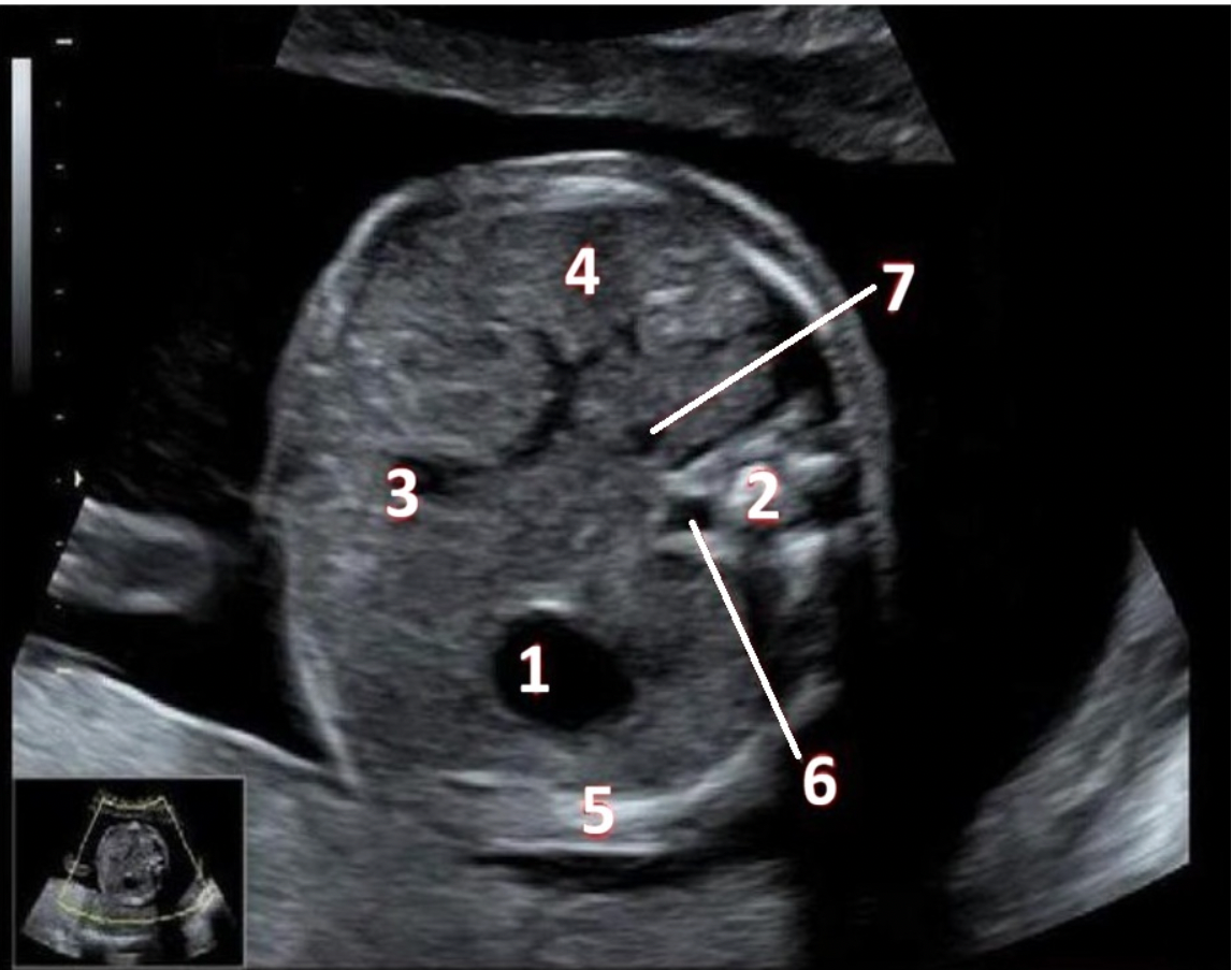 <p>What fetal structure is indicated by #1?</p><p>A. gallbladder</p><p class="p1">B. rib</p><p class="p1">C. stomach</p><p class="p1">D. liver</p>