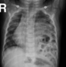 <p><span><span>Baby with following imaging, no left lung sounds What is the abnormality ?</span></span></p>