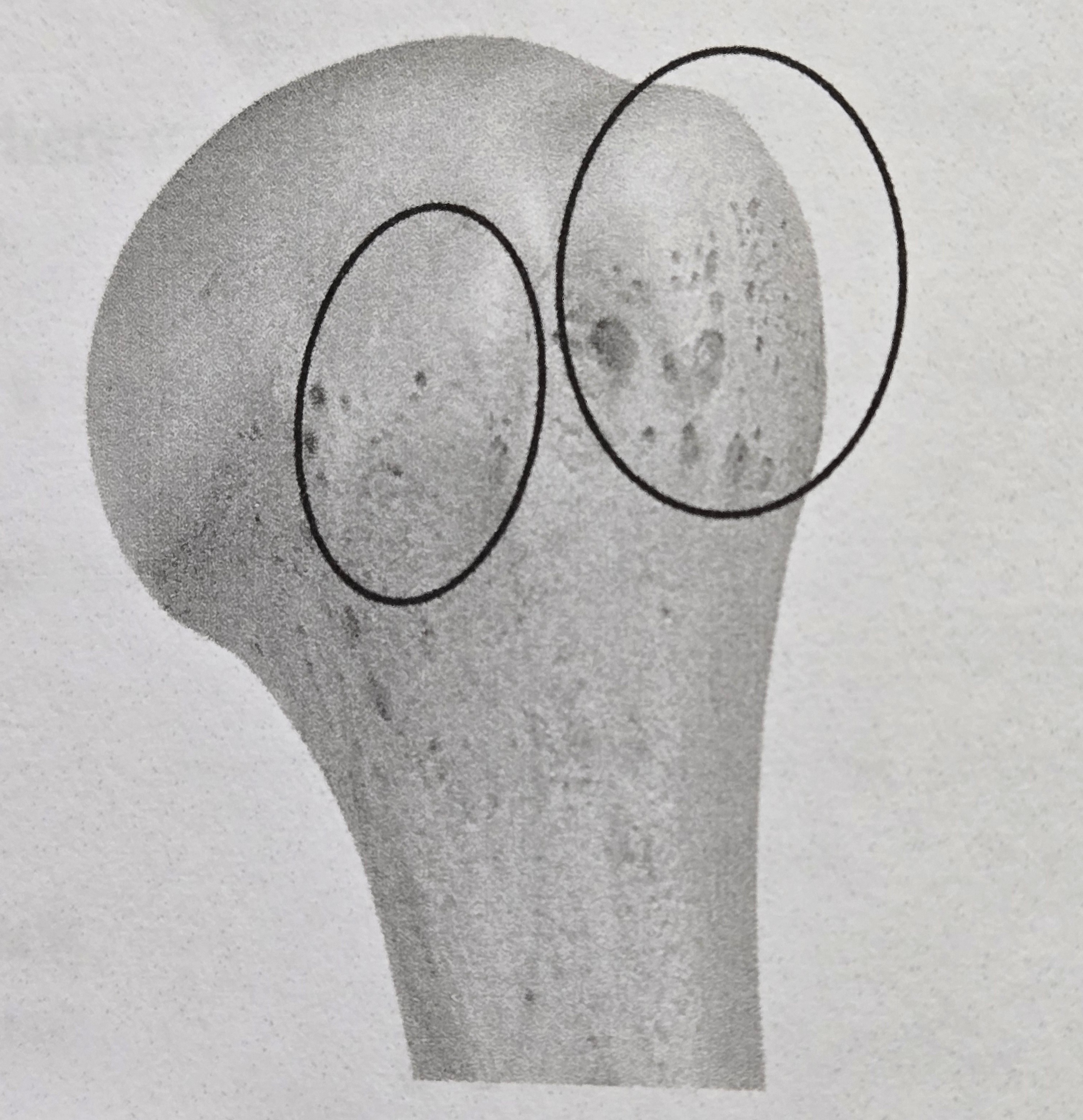 <p>Tubercle</p>