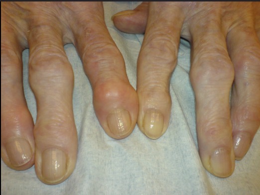 <p>Bony prominence at distal interpharyngeal joint</p><p>Associated with osteoarthritis </p>