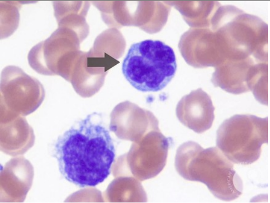 <p>A 60-year-old white male presents with complaints of a diffuse erythematous pruritic rash over the majority of the body. On physical exam, there is diffuse lymphadenopathy and erythroderma involving more than 90% of the skin surface. Biopsy reveals the findings in the attached image. What is the most likely diagnosis?</p>