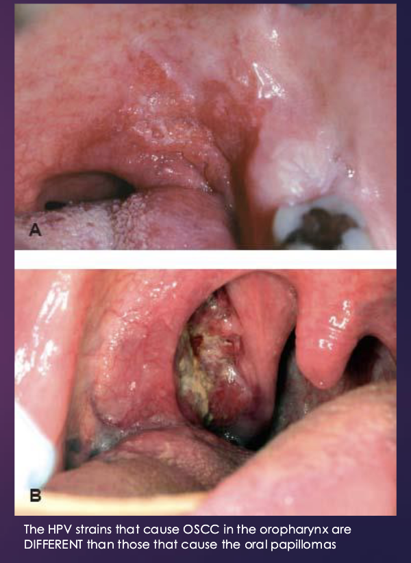 <p><strong>Papilloma </strong>and <strong>Oral Cancer (OSCC):</strong></p>