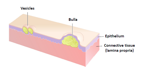 <p>a raised lesion filled with pus </p>