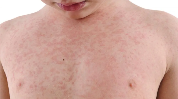 <p>German measles.</p>