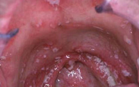 <p>radiation therapy induced </p>